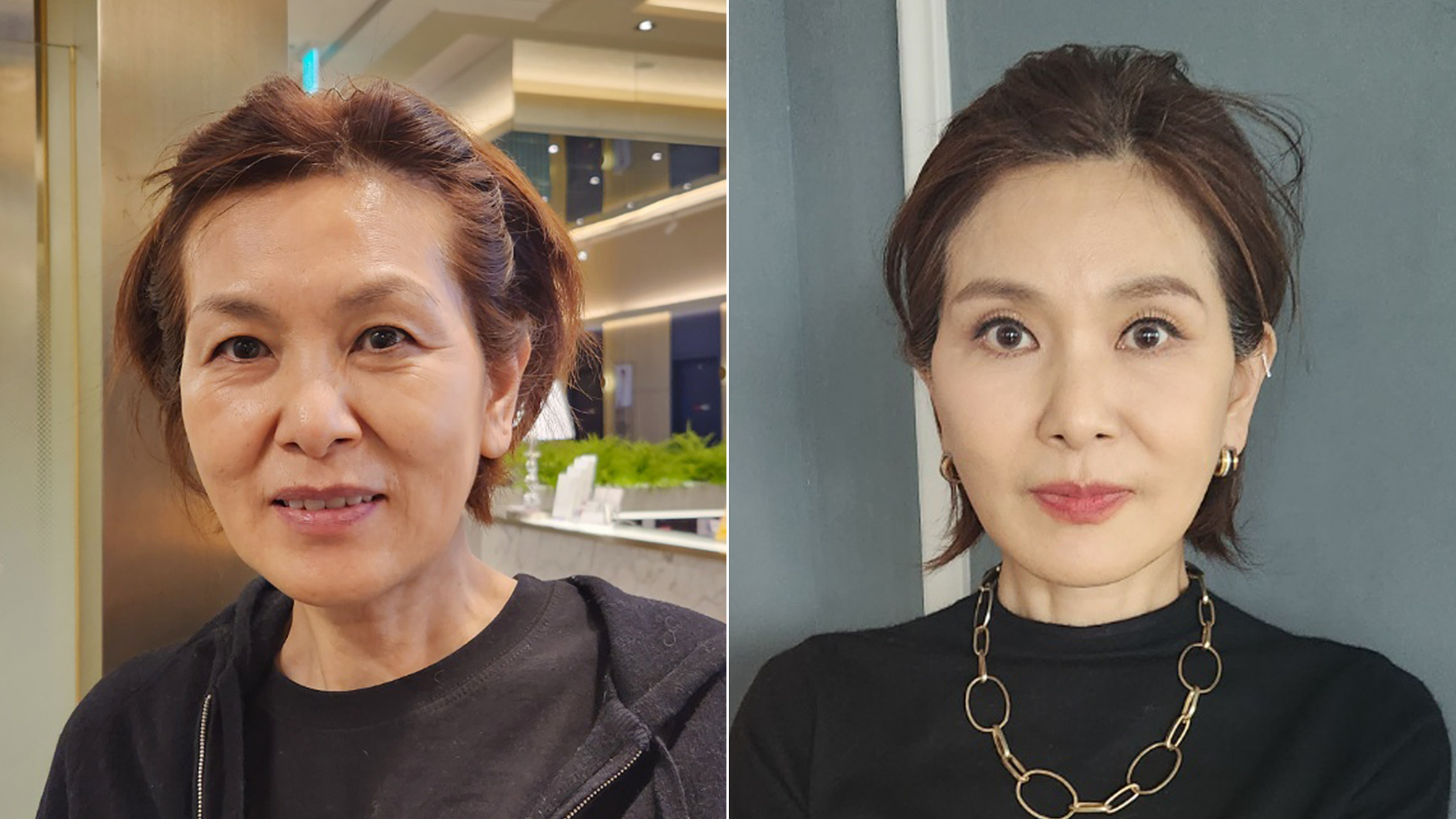 한국 리프팅, 세계가 선택하는 이유